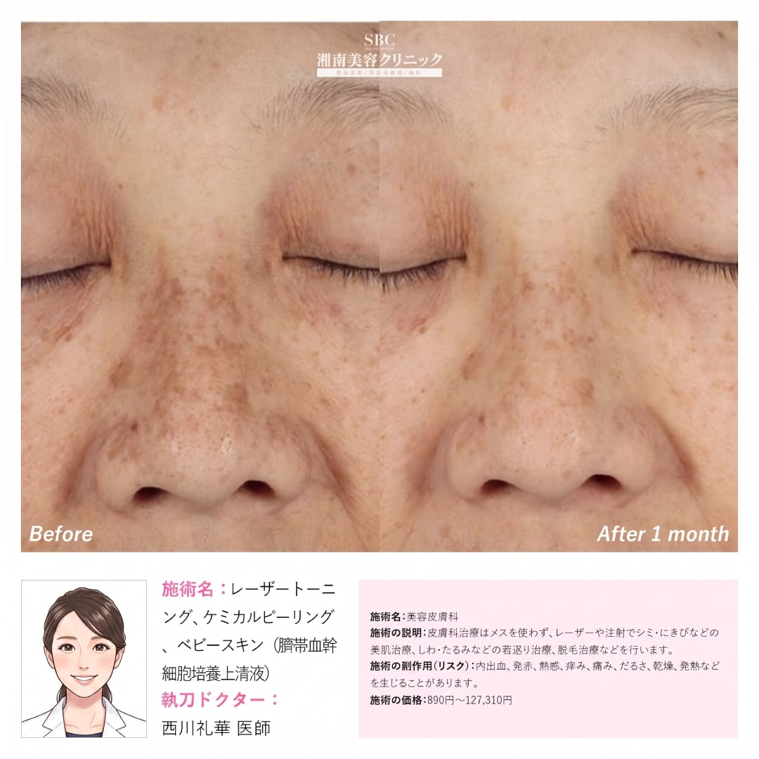シミ取り初体験の方はコレ！