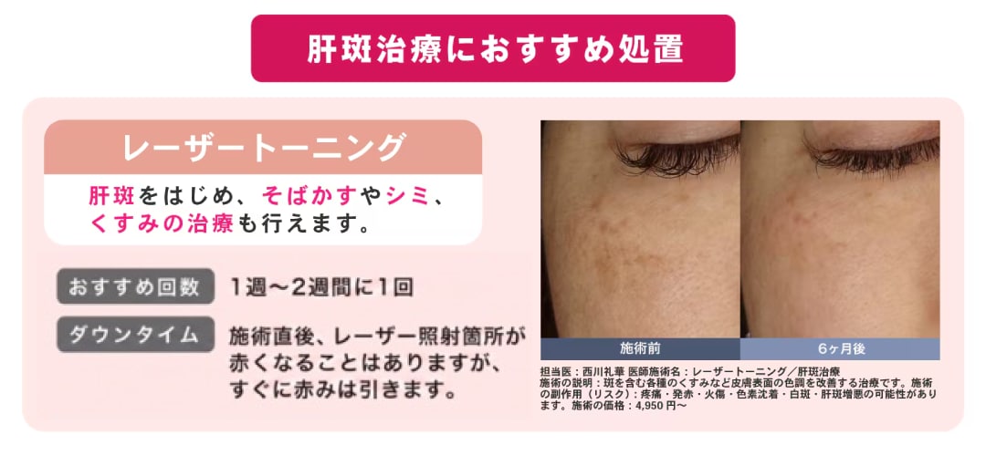 肝斑が悪化する？！危険なレーザー選び。