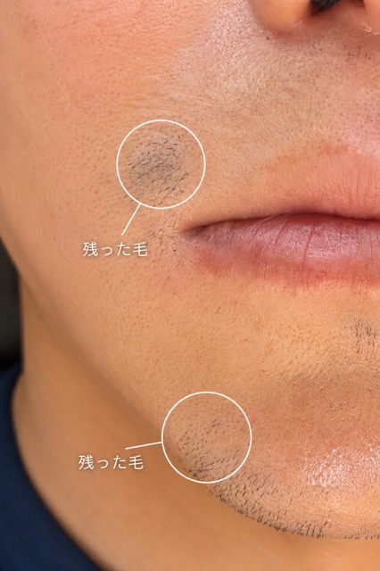 予算内で賢く脱毛したい！