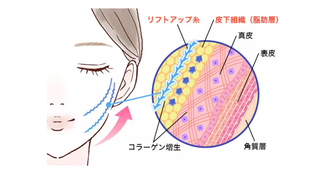 お悩み別！糸リフトは何を選ベばいい？<br />
