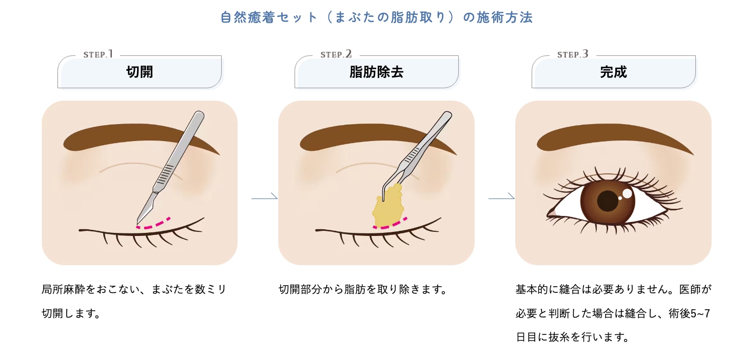 極細の医療用糸で二重を作ってまぶたを数ミリ切開。ぱっちり目を作る！