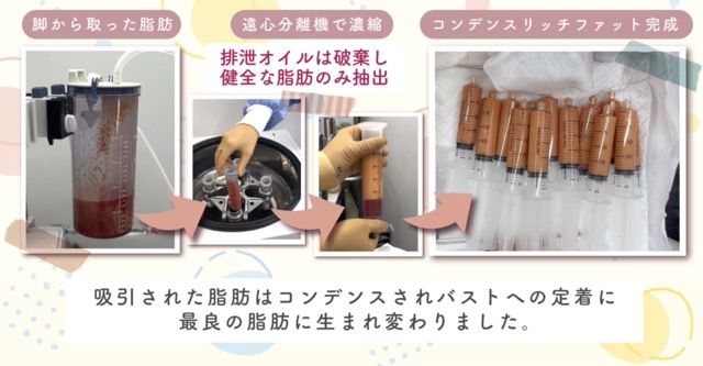 Q.1回のバストへの注入量はどれぐらい？