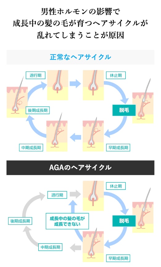 なぜ薄毛・抜け毛が起こる？
