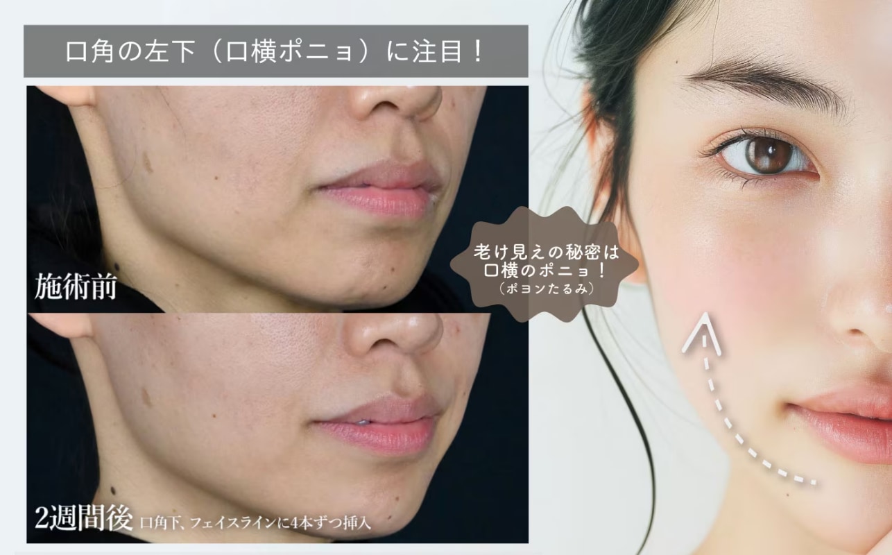 横ポニョが引き上がっていると印象が若く見える！