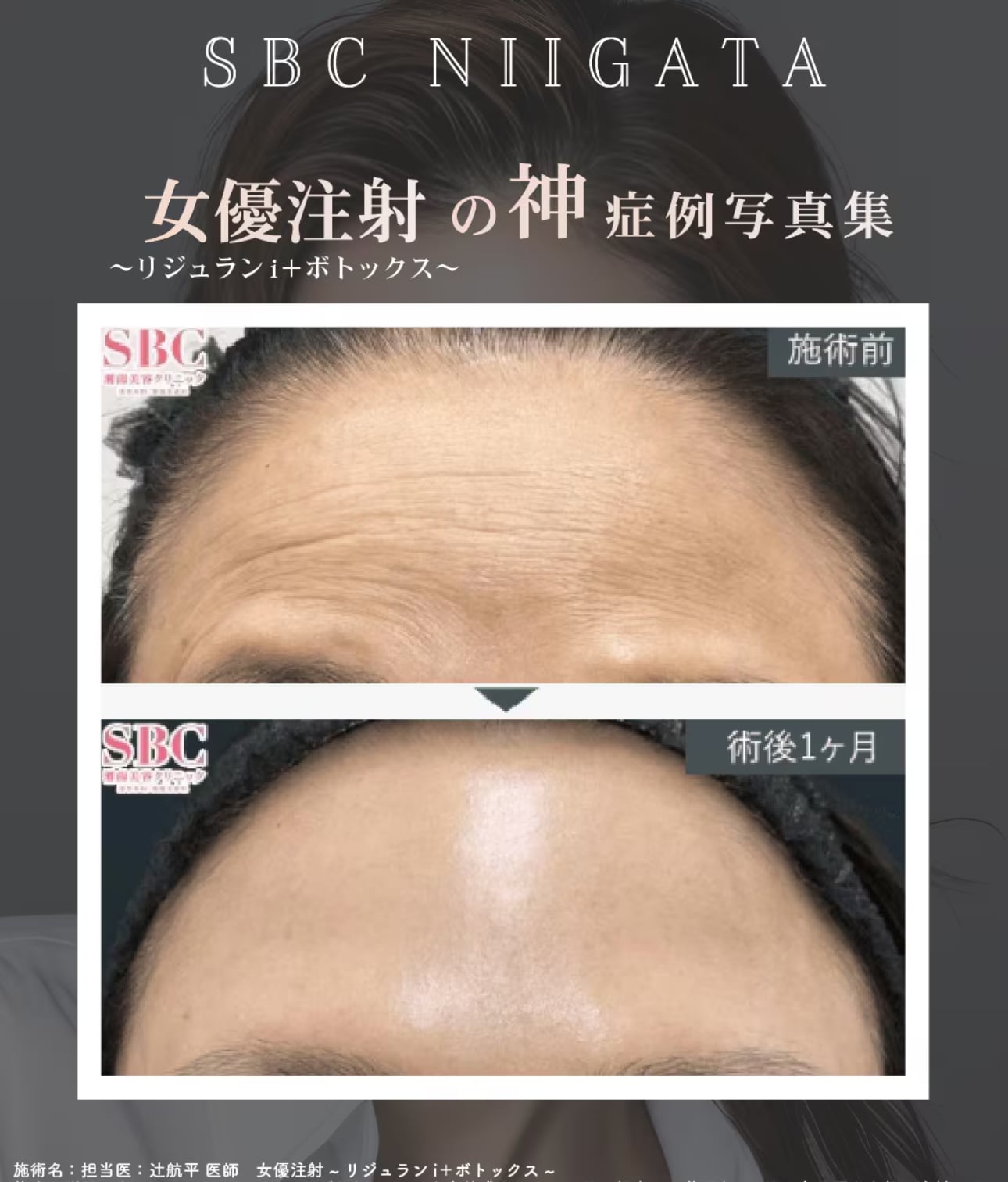 透明肌を目指す肌育注射