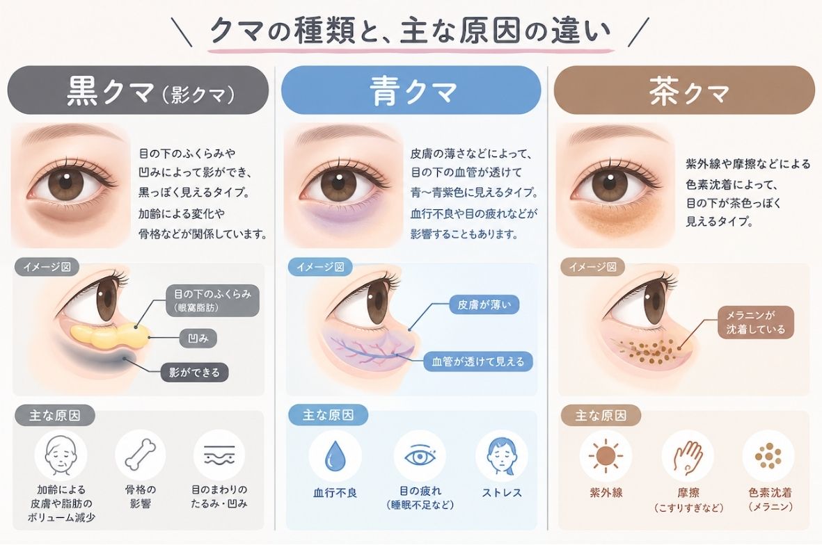 目の下のクマはなぜできる？3つのタイプと原因