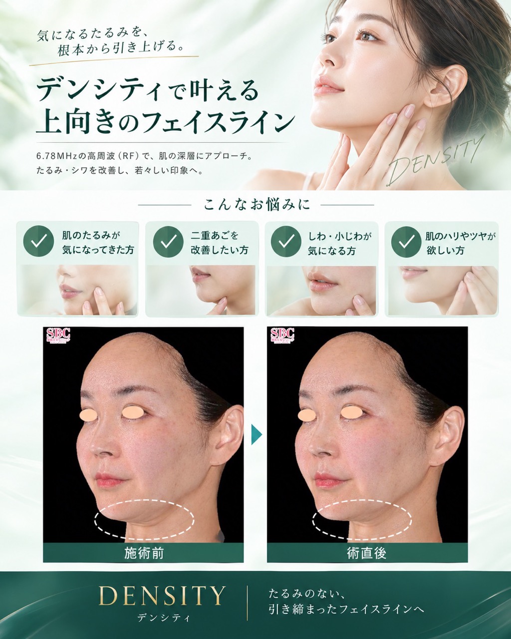 高周波エネルギーを利用して真皮層や脂肪層にアプローチする最新のたるみ治療！