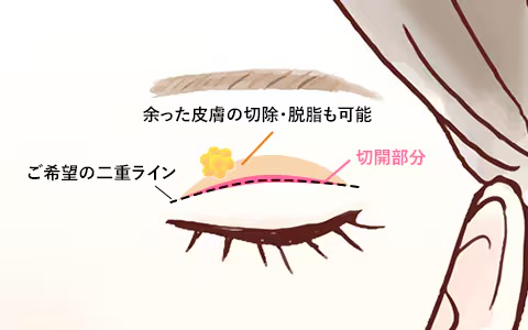 全切開法二重術(二重まぶた切開法)とは<br />