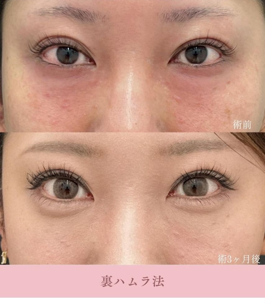 裏ハムラ法・切開ハムラ法が適している状態とは