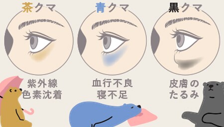 目の下のクマは、主に3種類