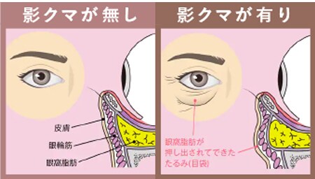 影クマの原因になる眼窩脂肪