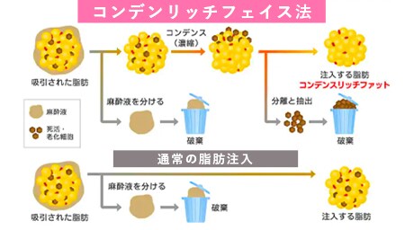 脂肪注入の種類①:コンデンスリッチフェイス法