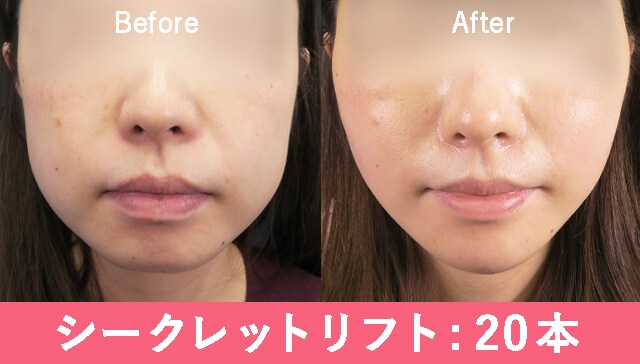 糸1種類の場合