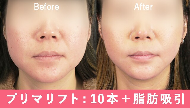 糸リフト+脂肪吸引の場合