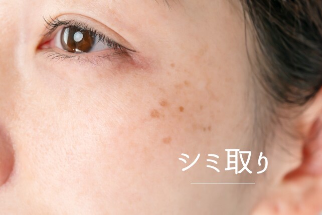 レーザー皮膚科「シミ取り治療」