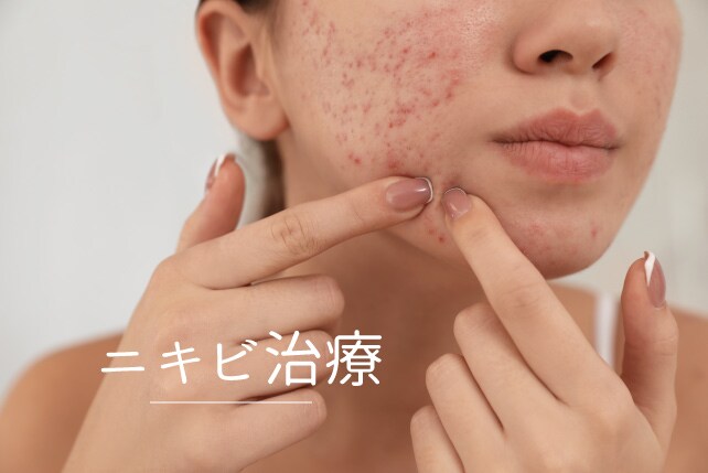 症状に合わせて治療を選べる「ニキビ治療」