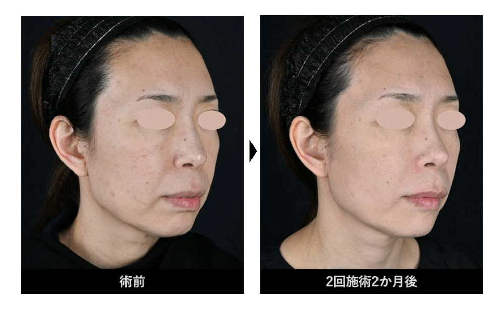 肌そのものを再構築する“次世代ヒアルロン酸”