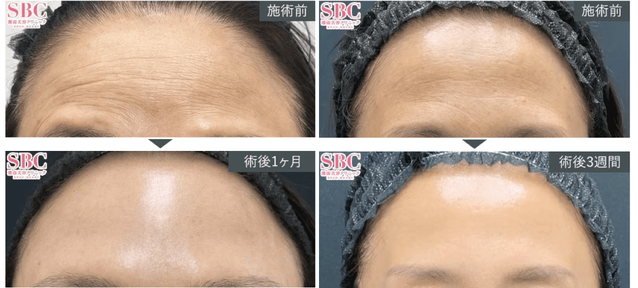 BEFORE / AFTER