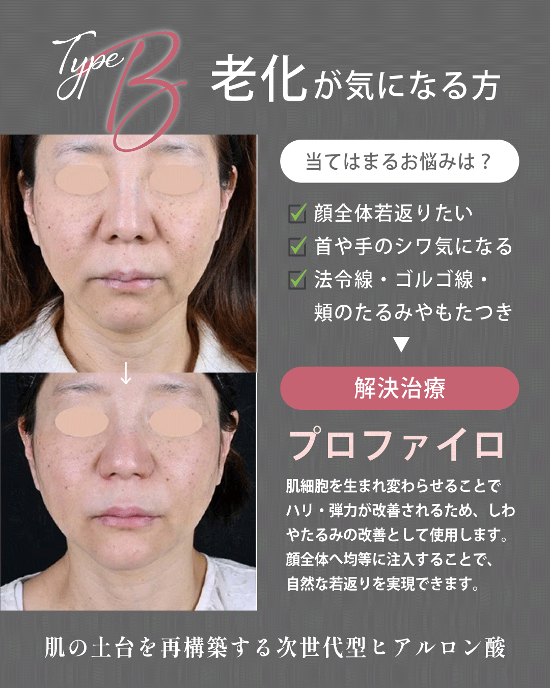 タイプBさん