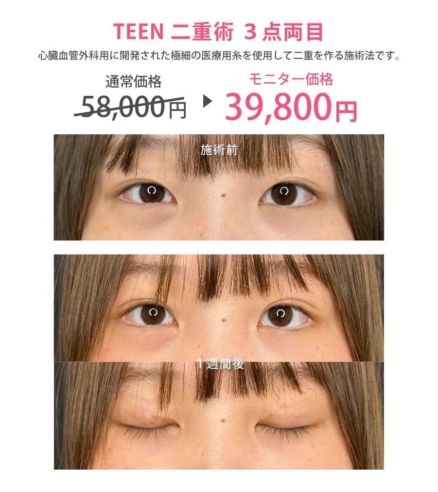 室井医師の二重整形症例写真