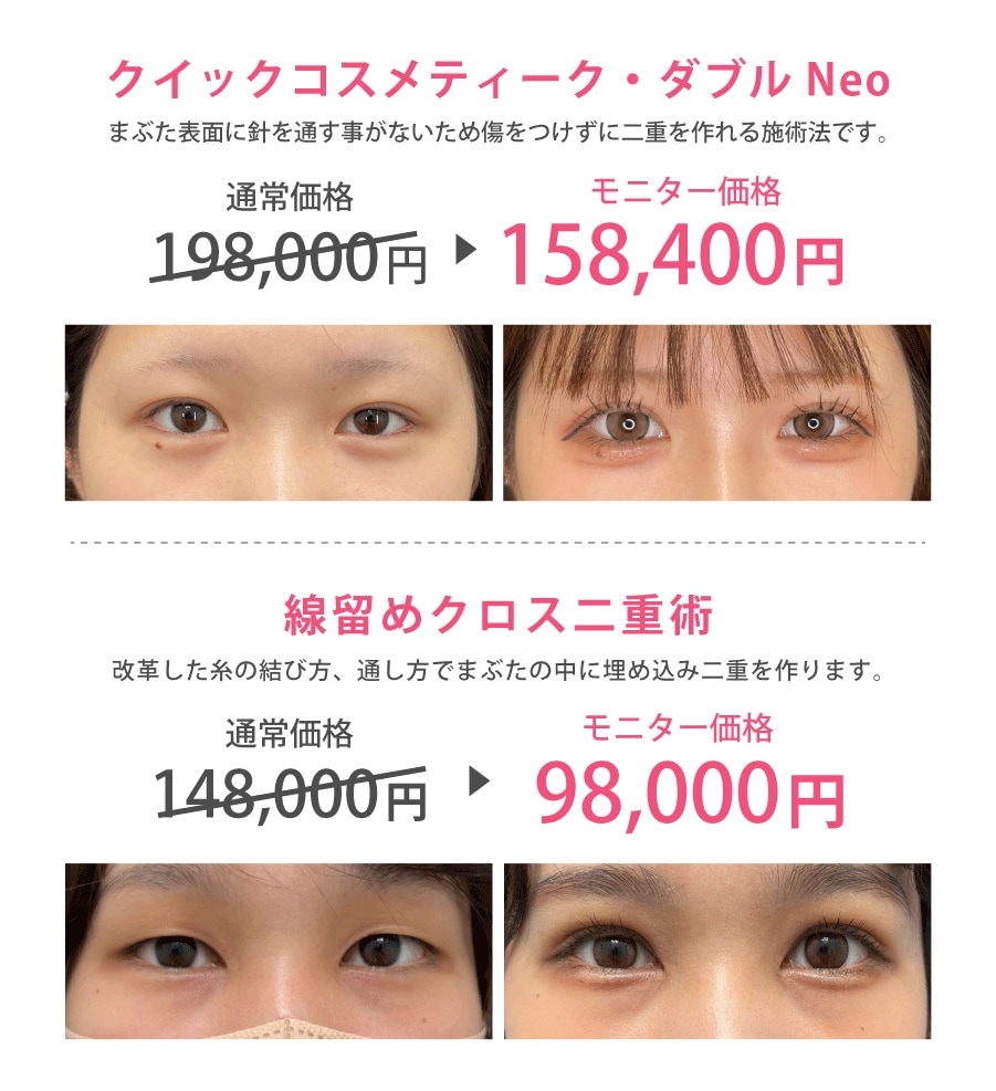 山口院長の二重埋没症例写真