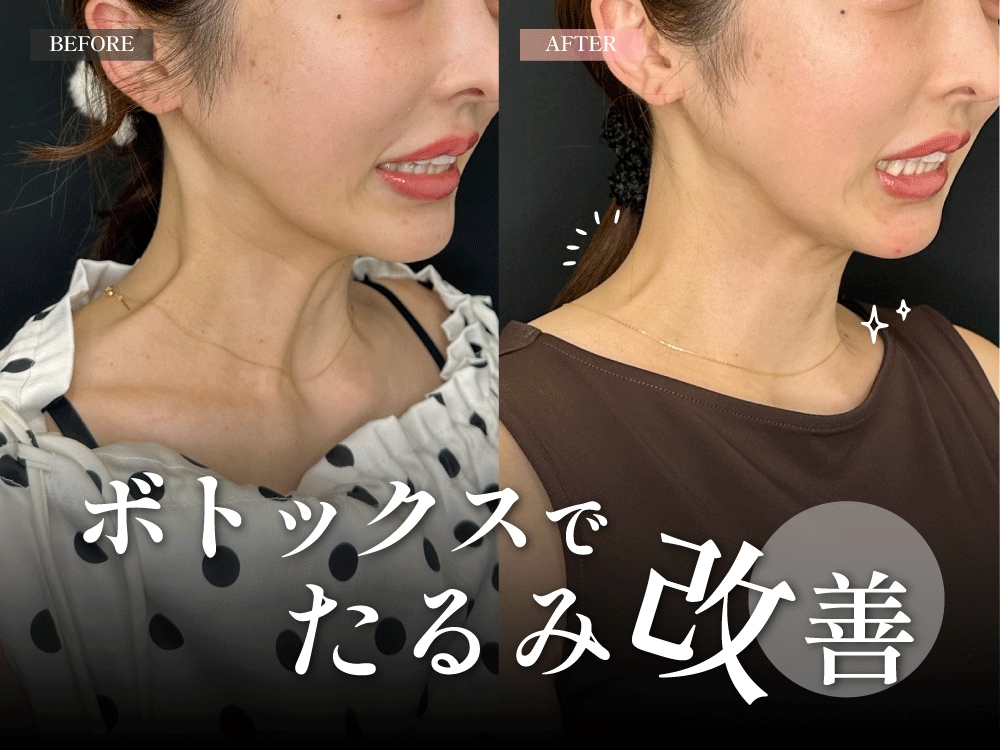 【関西で話題】ボトックスリフトでたるみ改善！兵庫で若返り施術ならSBC西宮北口院がおすすめ