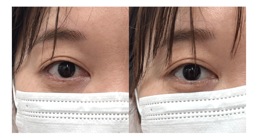 <b>目の充血改善</b>( 左がBEFORE / 右がAFTER )
