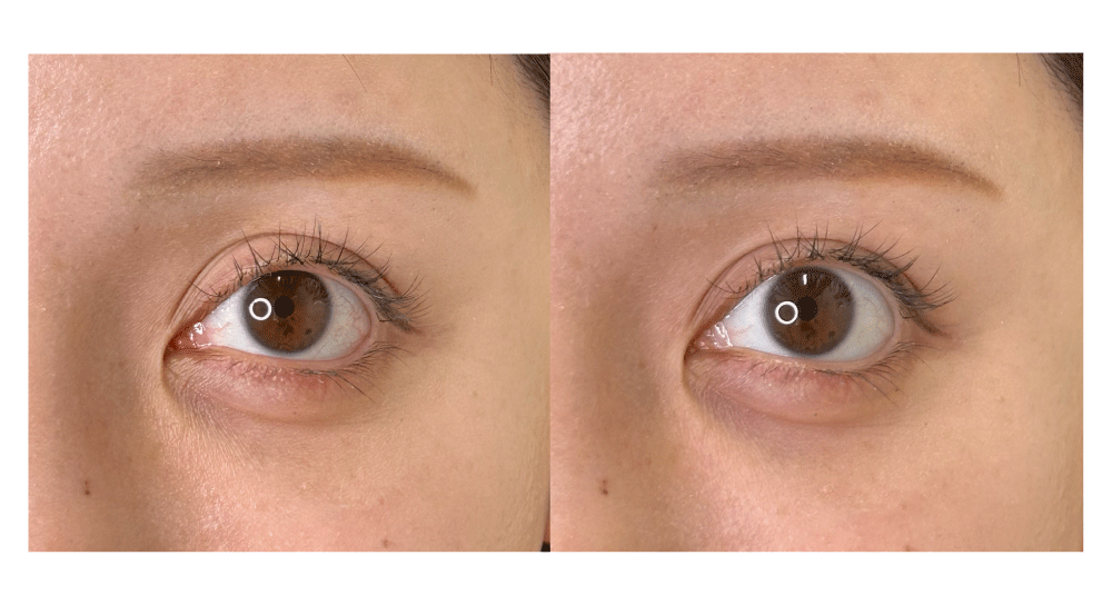 <b>眼瞼下垂の解消</b>( 左がBEFORE / 右がAFTER )