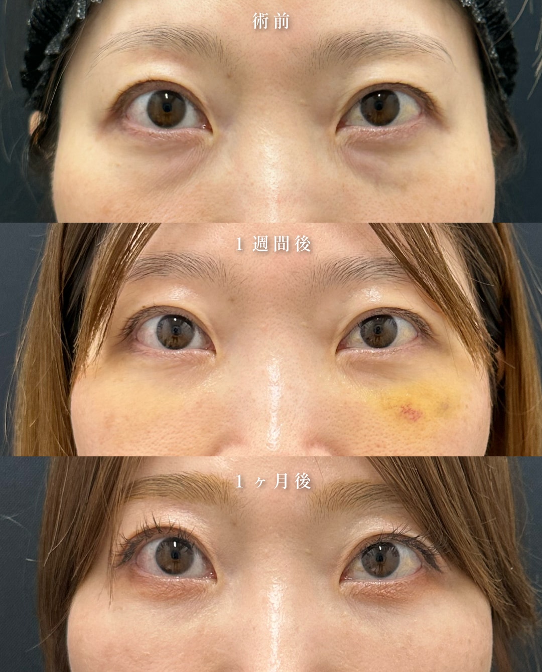 脱脂＋脂肪注入（コンデンスリッチ,ナノリッチ）