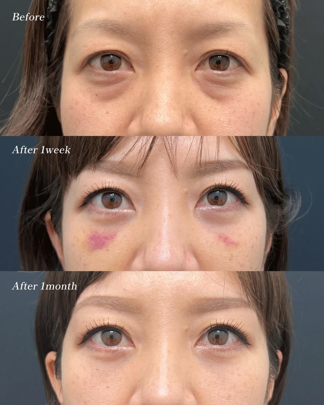 脱脂＋脂肪注入（コンデンスリッチ）