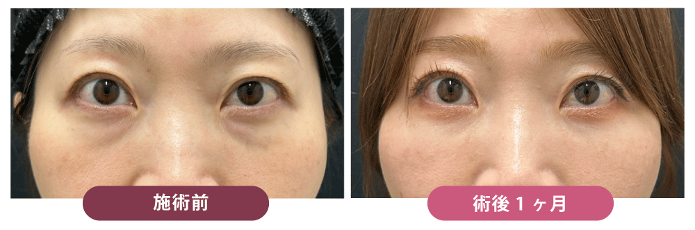 ”黒クマ（影クマ）”