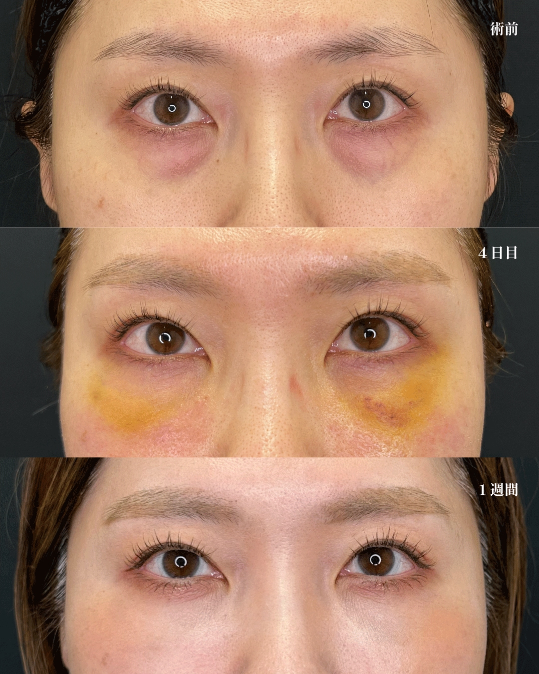 脱脂＋脂肪注入（コンデンスリッチ,ナノリッチ）