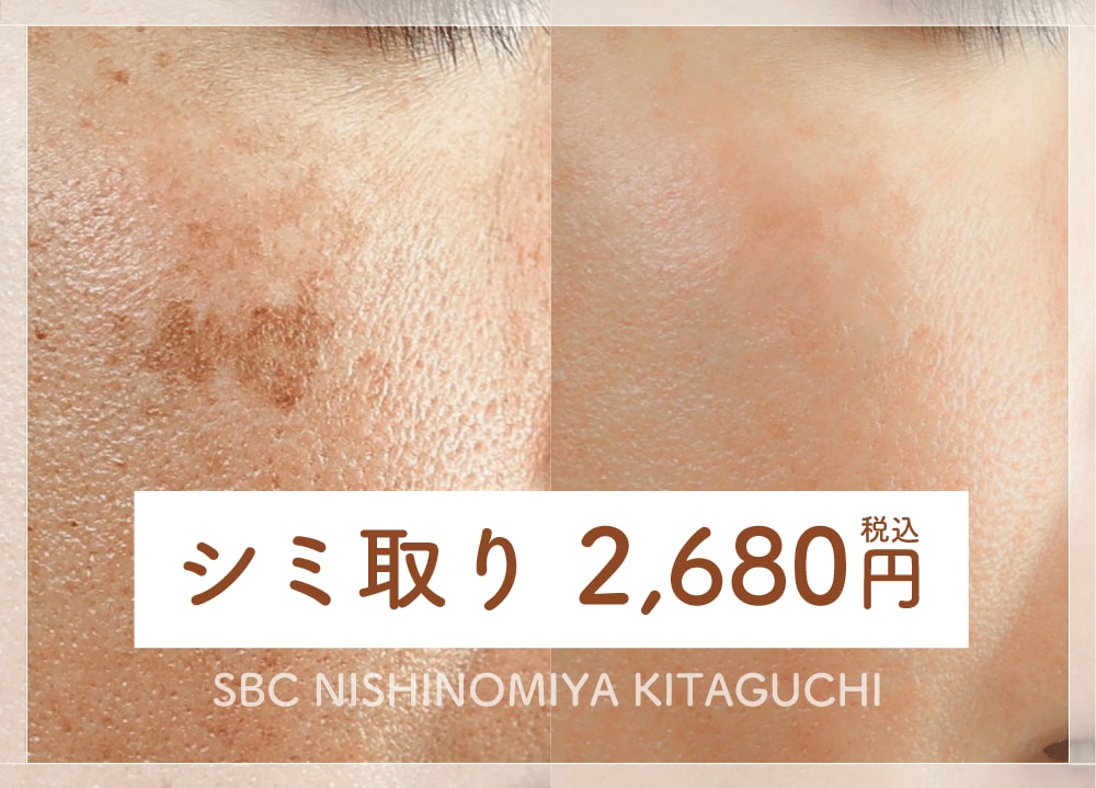 【兵庫でシミ取り】湘南美容クリニック西宮北口院の安い”シミ取り治療”|料金・効果・症例を徹底解説
