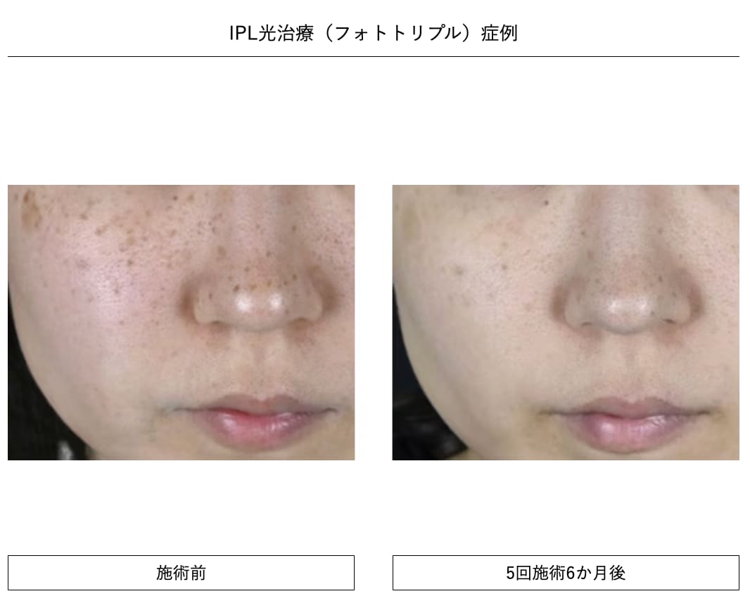 2,680円でシミを撃退するならSBC西宮北口院!