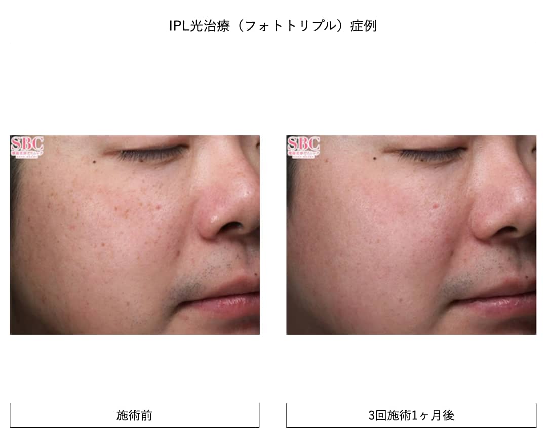 2,680円でシミを撃退するならSBC西宮北口院!