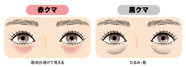 ✅ 黒クマ,赤クマ＝「脱脂＋注入」