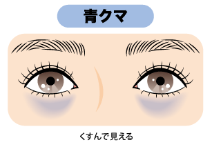 ✅ 青クマ＝脂肪注入（コンデンスリッチ,ナノリッチ）