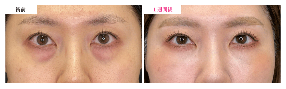 ① クマ取り（目の下のふくらみ取り）