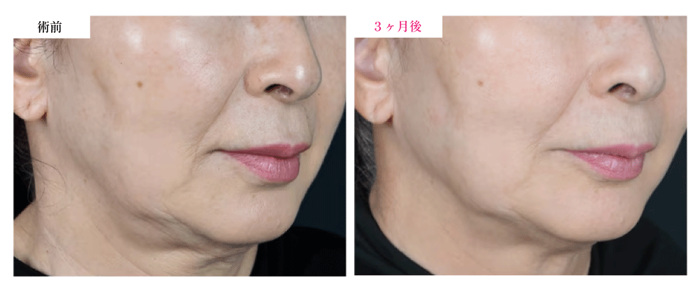 ② デンシティ（スキンブースター）