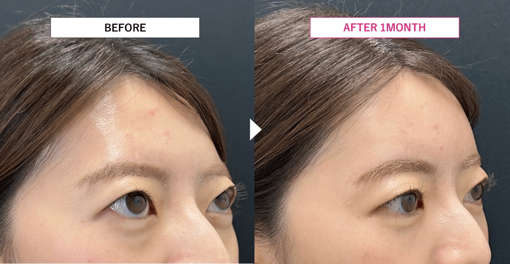 クマだけでなく脂肪注入も自然に変化✨