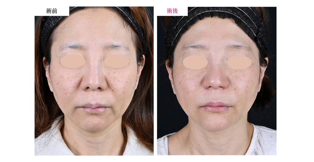 ③ プロファイロ（次世代の若返り治療）