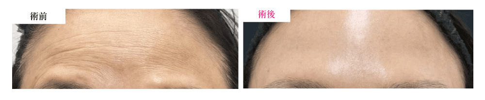 ④ 女優注射（ボトックス＋リジュラン）