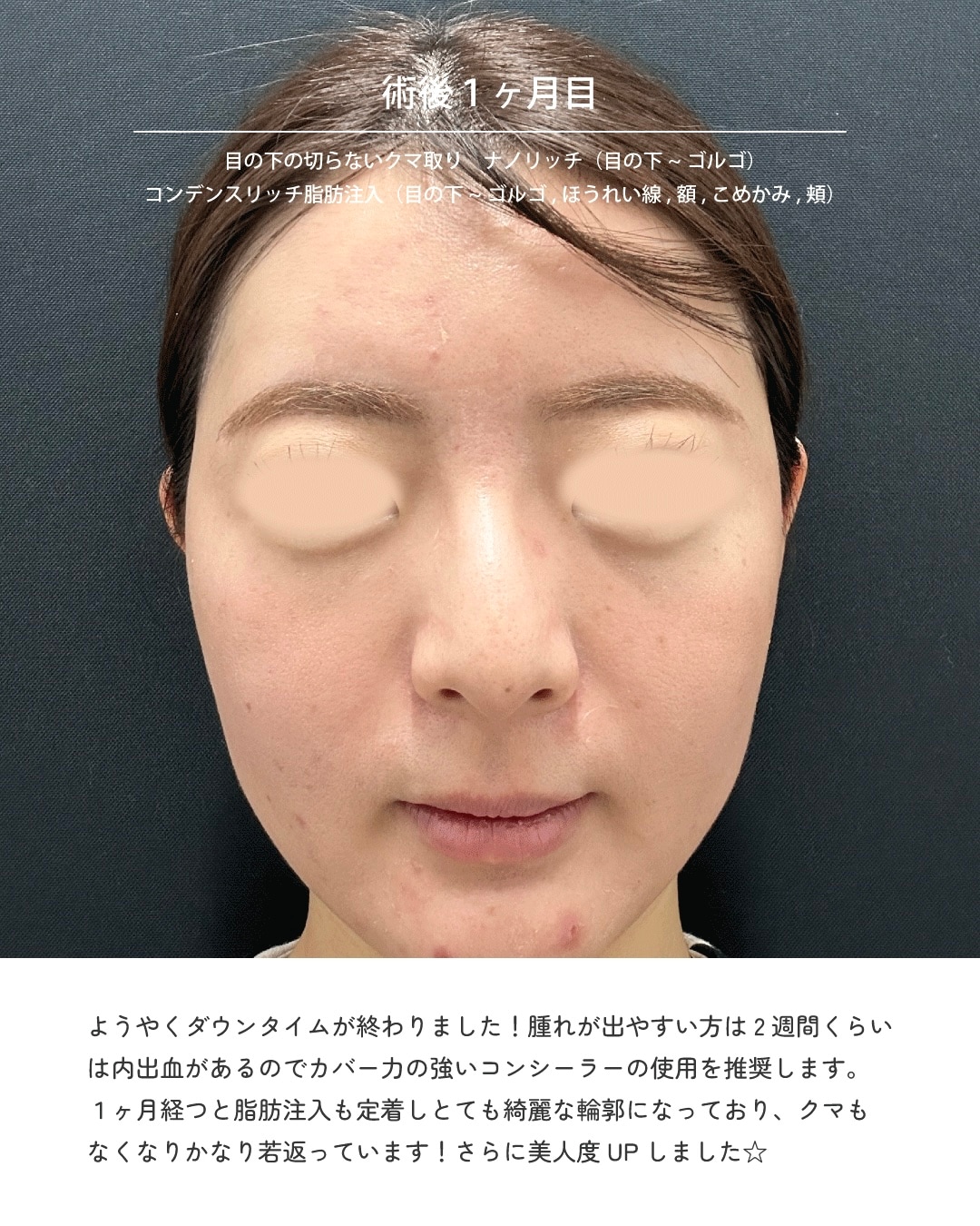 ● 術後1ヶ月目