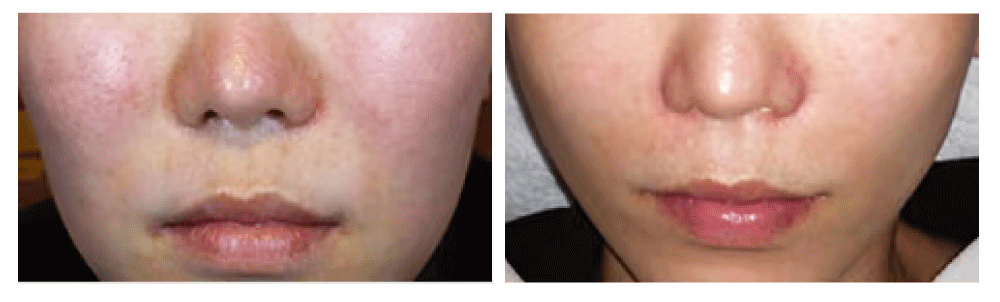 ⑦ エレクトロポレーション（イオン導入）