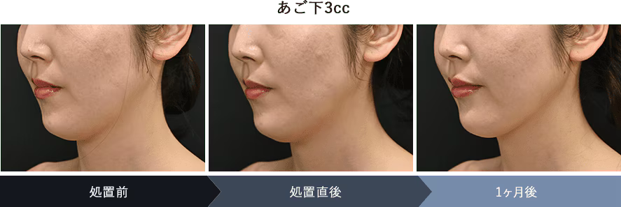 ⑤ 脂肪溶解注射 FatX Core（頬・アゴ下・二の腕などの強力部分痩せ）