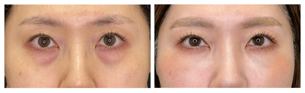 ① 切らないクマ取り