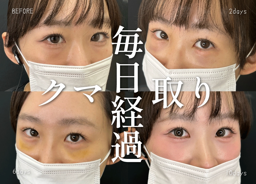 【画像付き】目の下のクマ取りダウンタイムは何日?腫れ・内出血の経過どれくらいかかるのかと早く治す方法を完全ガイド|神戸・西宮北口