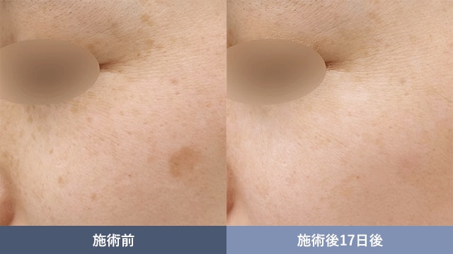 コスパよく確実にシミを撃退したい方へ