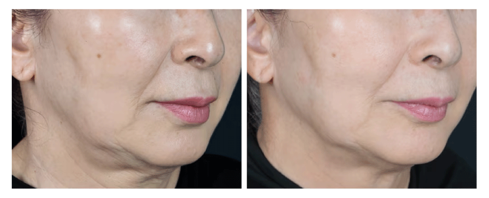 ② ハイフ・デンシティ