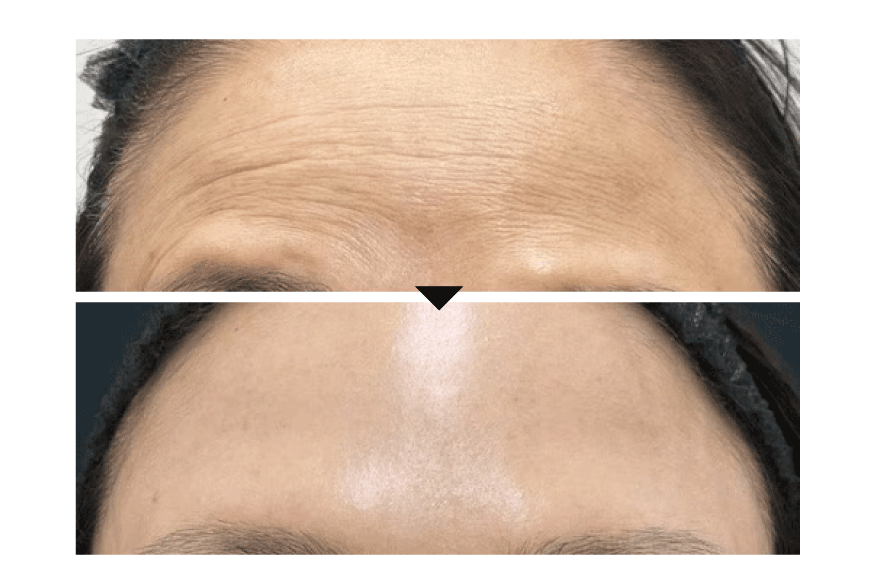 女優注射の効果実感と回数